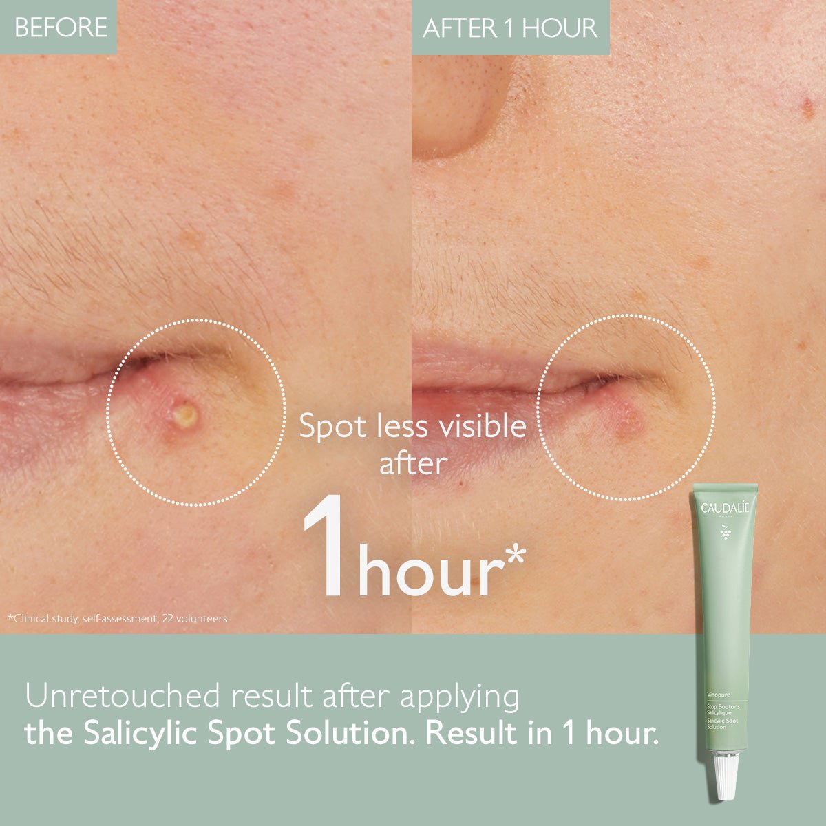 VINOPURE Alicylzuur Spot Treatment - MaPeau