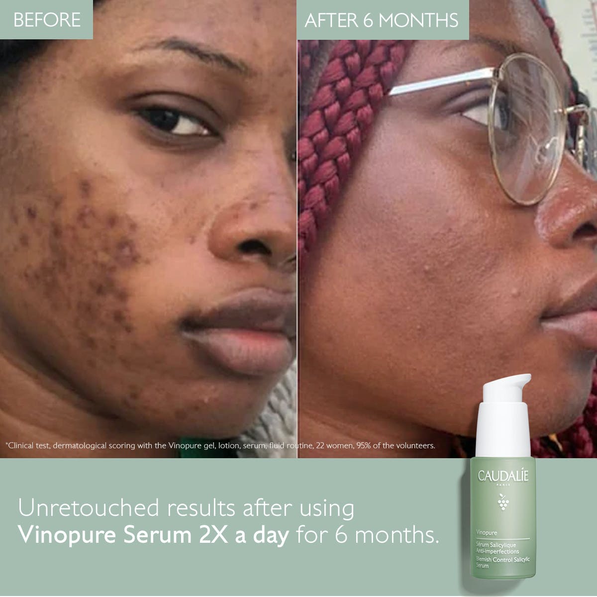 VINOPURE Serum met Salicylzuur tegen Onzuiverheden - MaPeau