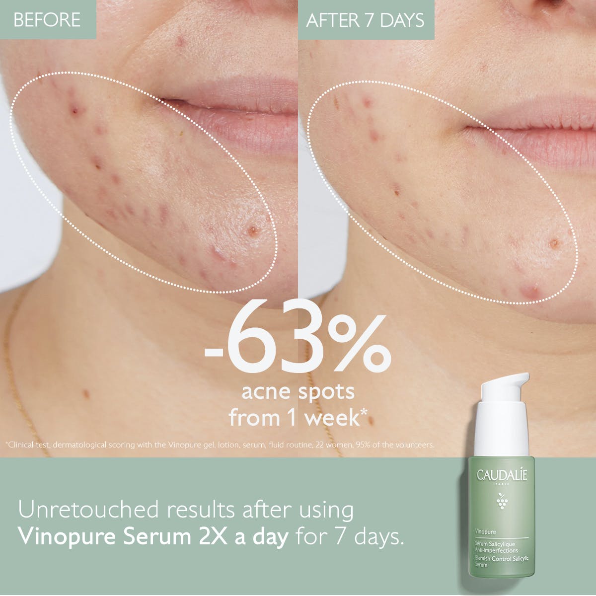 VINOPURE Serum met Salicylzuur tegen Onzuiverheden - MaPeau